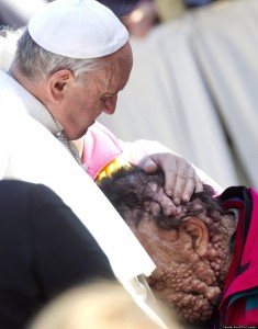 Pope Francis embraces man with boils